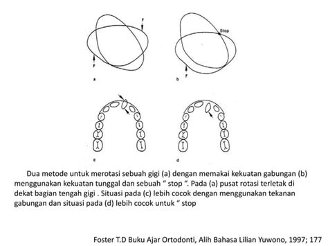 Biomechanics of tooth movement Biomekanika pergerakan gigi.